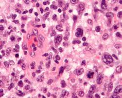 間變性大細胞淋巴瘤